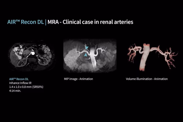 MRA - Cas clinique des artères rénales